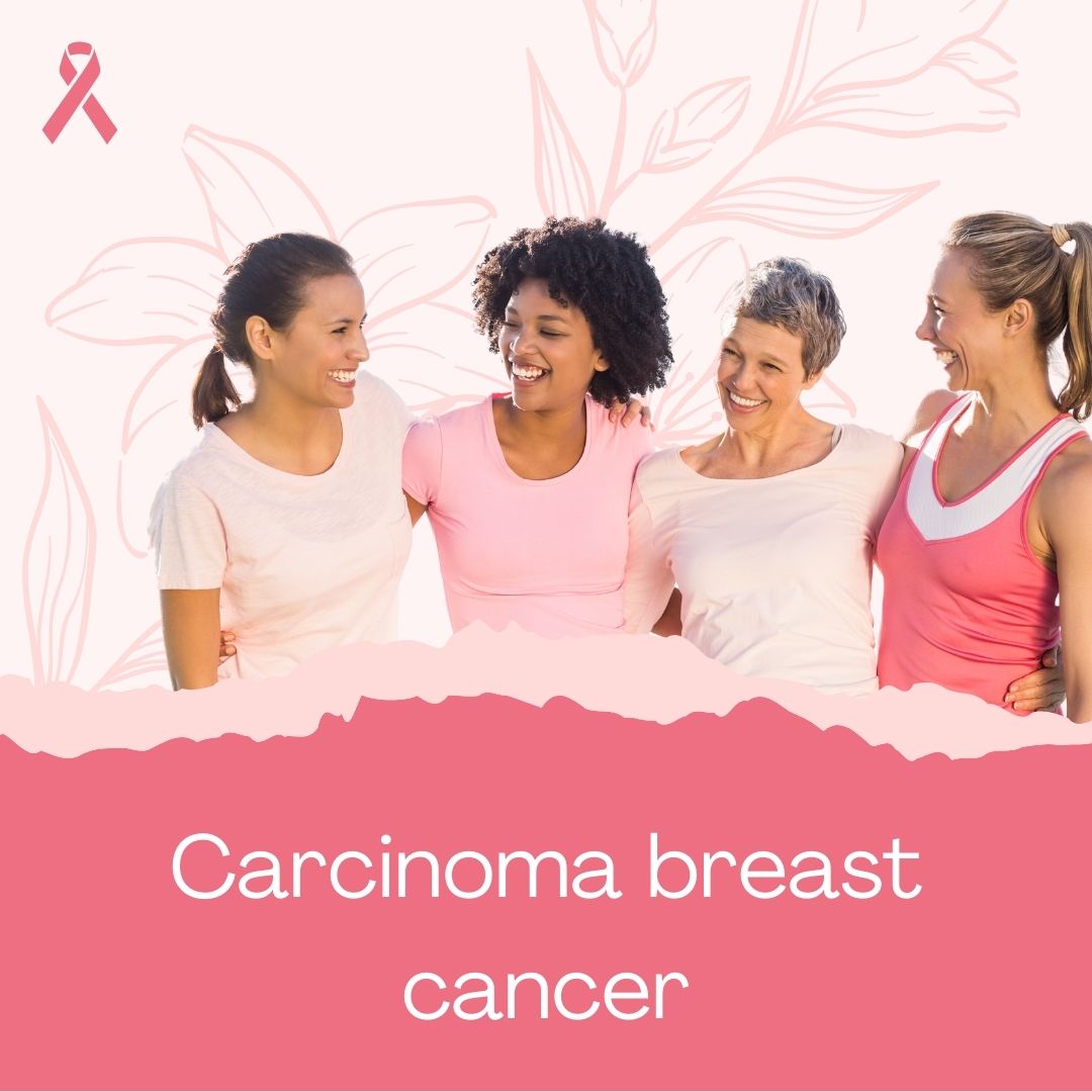 Carcinoma breast cancer: types, treatment, stage 1, stage 2, stage 3, stage 4