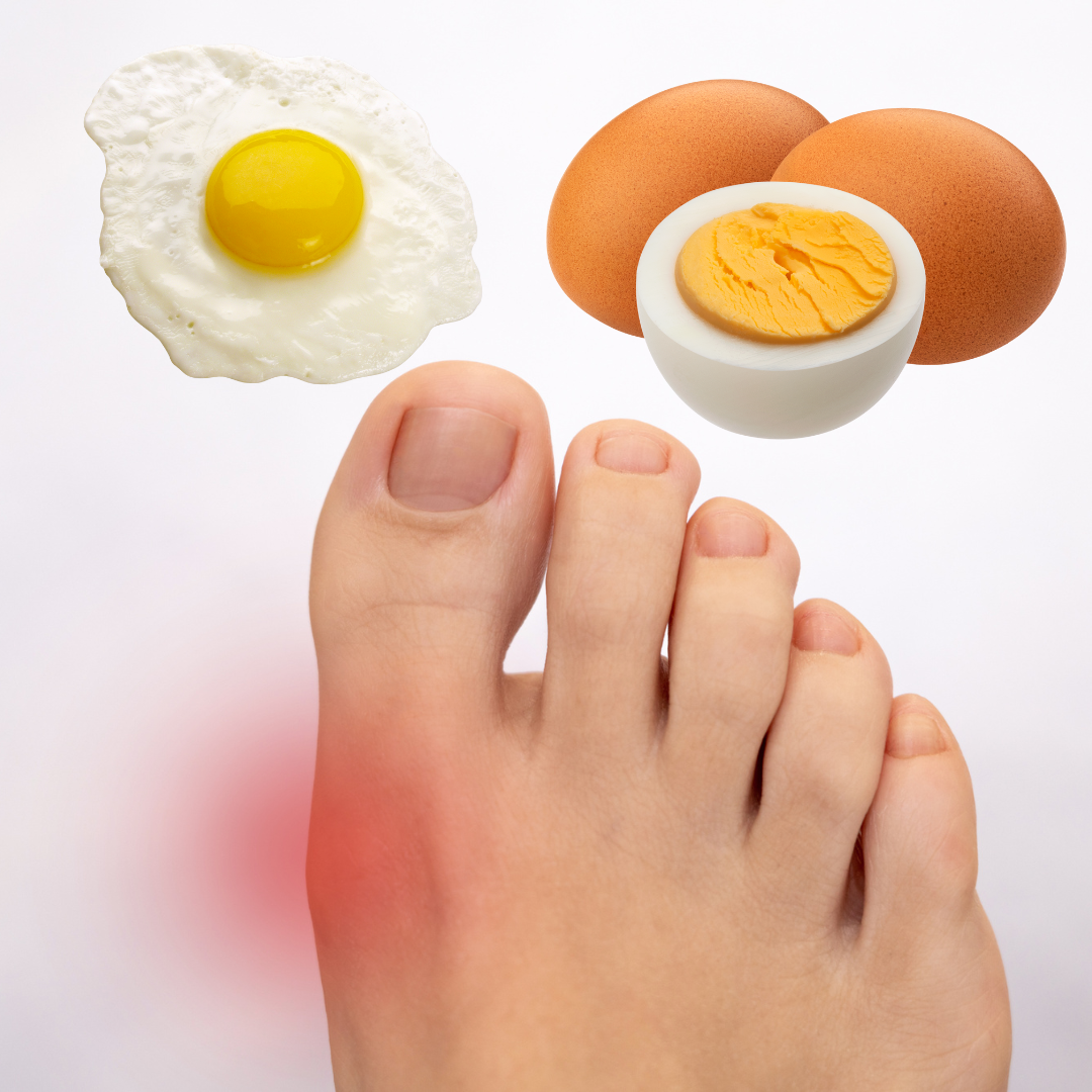 Eggs and Gout